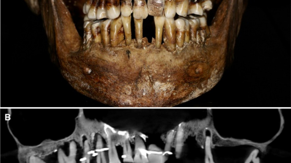 French aristocrat's golden dental secret revealed 400 years on