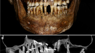 French aristocrat's golden dental secret revealed 400 years on